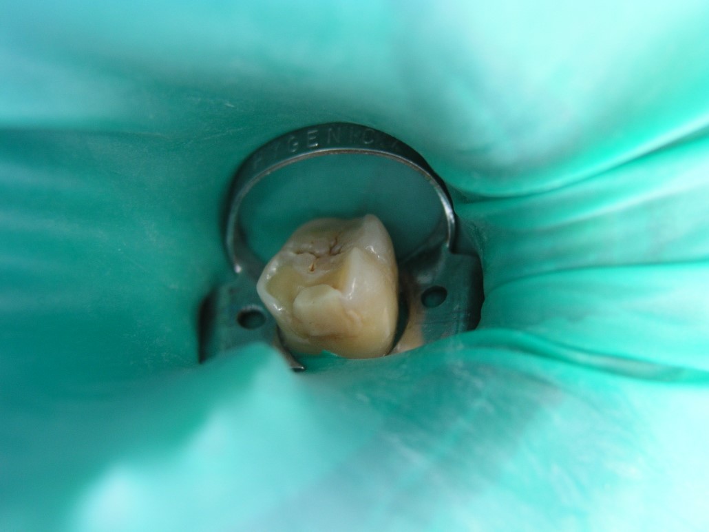 diente-endodoncia-ibiza-
